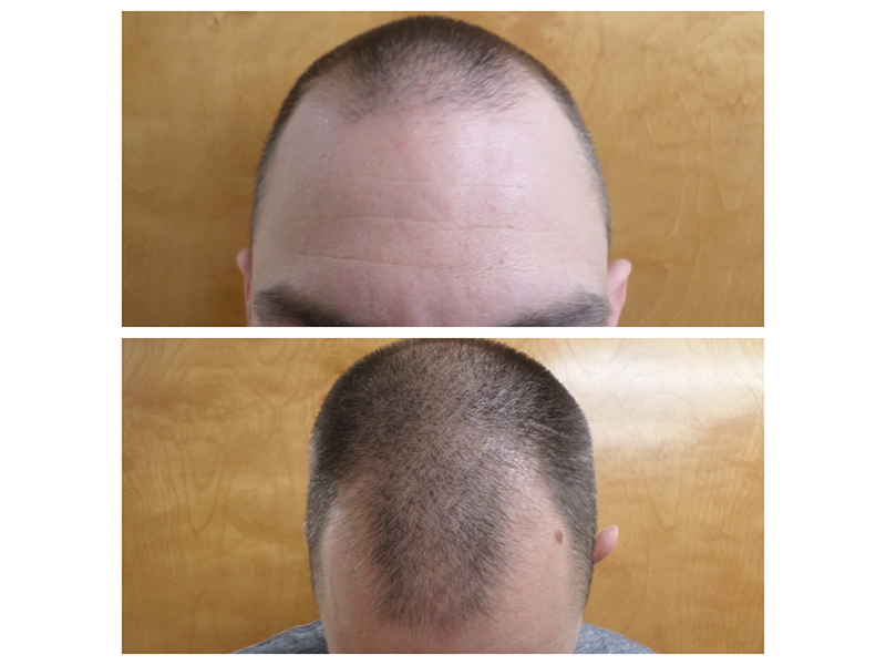 Hair Transplants: How Much Does it Cost? post thumbnail image