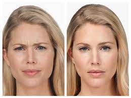 What is Botox Santa Barbara and How Can it Improve Your Appearance? post thumbnail image
