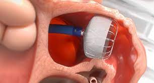 Watchman Device: Restoring Peace of Mind for Atrial Fibrillation Sufferers post thumbnail image