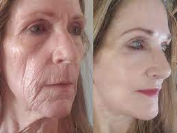 Revive Your Beauty Nearby: Skin Tightening Facial Options post thumbnail image